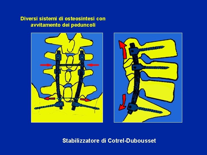 Diversi sistemi di osteosintesi con avvitamento dei peduncoli Stabilizzatore di Cotrel-Dubousset 
