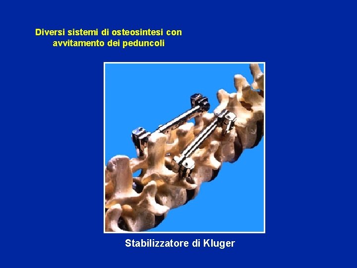 Diversi sistemi di osteosintesi con avvitamento dei peduncoli Stabilizzatore di Kluger 