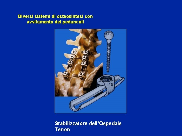 Diversi sistemi di osteosintesi con avvitamento dei peduncoli Stabilizzatore dell’Ospedale Tenon 