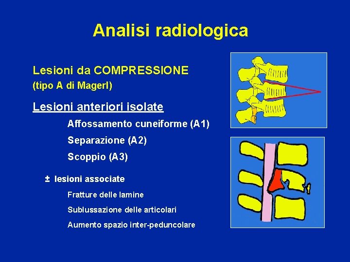 Analisi radiologica Lesioni da COMPRESSIONE (tipo A di Magerl) Lesioni anteriori isolate Affossamento cuneiforme