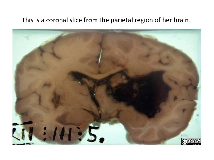 This is a coronal slice from the parietal region of her brain. University of
