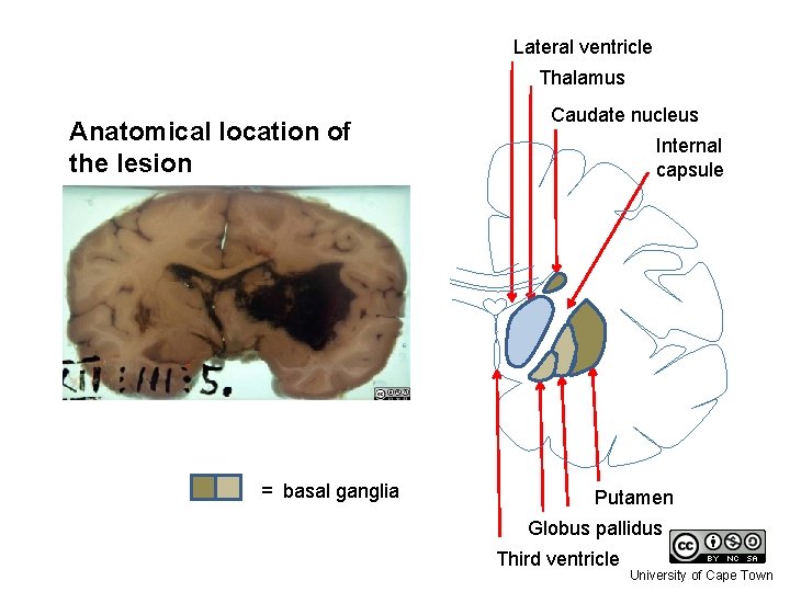 Lateral ventricle Thalamus Anatomical location of the lesion = basal ganglia Caudate nucleus Internal