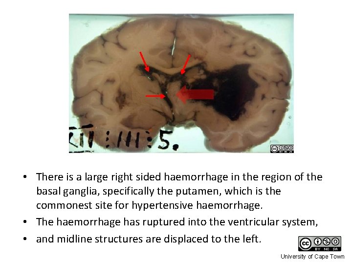  • There is a large right sided haemorrhage in the region of the