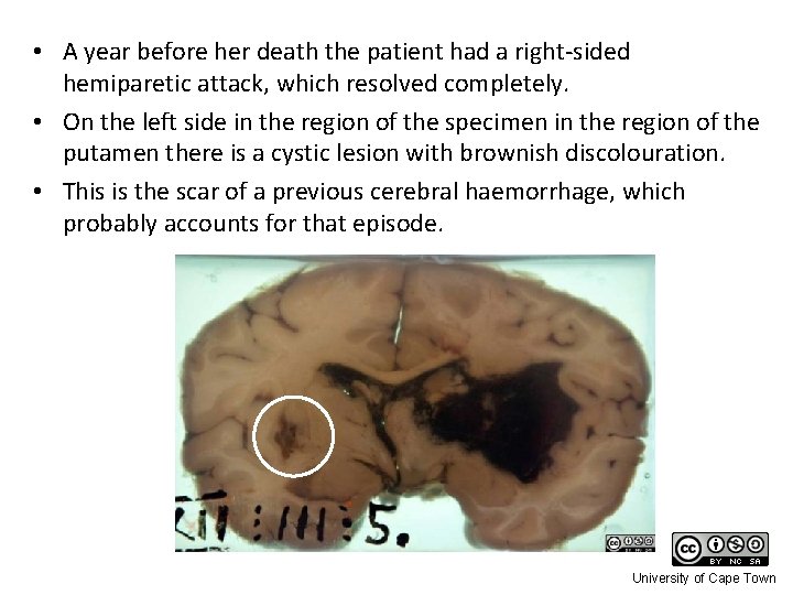 • A year before her death the patient had a right-sided hemiparetic attack,
