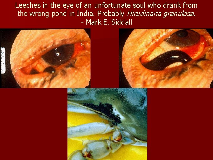 Leeches in the eye of an unfortunate soul who drank from the wrong pond