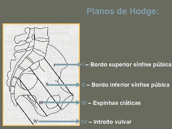 Planos de Hodge: I – Bordo superior sínfise púbica II – Bordo inferior sínfise
