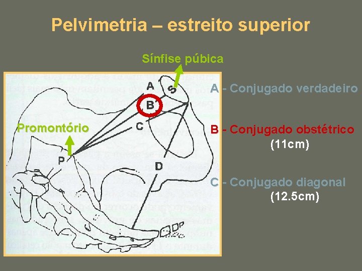 Pelvimetria – estreito superior Sínfise púbica A - Conjugado verdadeiro Promontório B - Conjugado