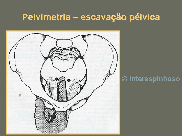 Pelvimetria – escavação pélvica interespinhoso 