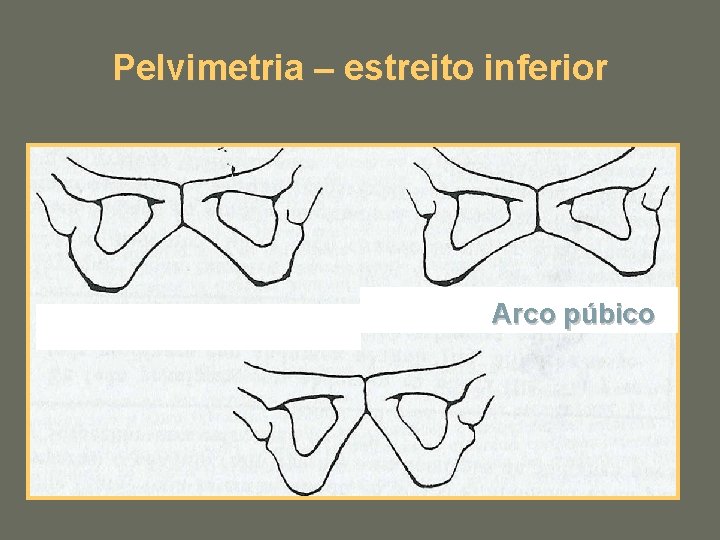 Pelvimetria – estreito inferior Arco púbico 