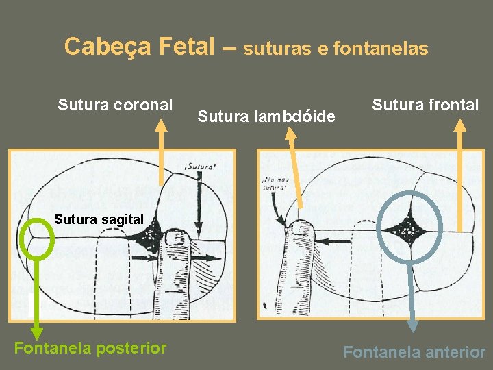 Cabeça Fetal – suturas e fontanelas Sutura coronal Sutura lambdóide Sutura frontal Sutura sagital