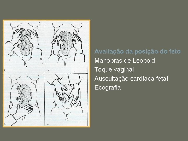 Avaliação da posição do feto Manobras de Leopold Toque vaginal Auscultação cardíaca fetal Ecografia