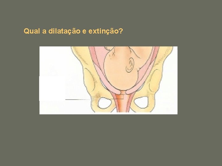 Qual a dilatação e extinção? Pélvis Dilatação do colo do útero Útero O colo