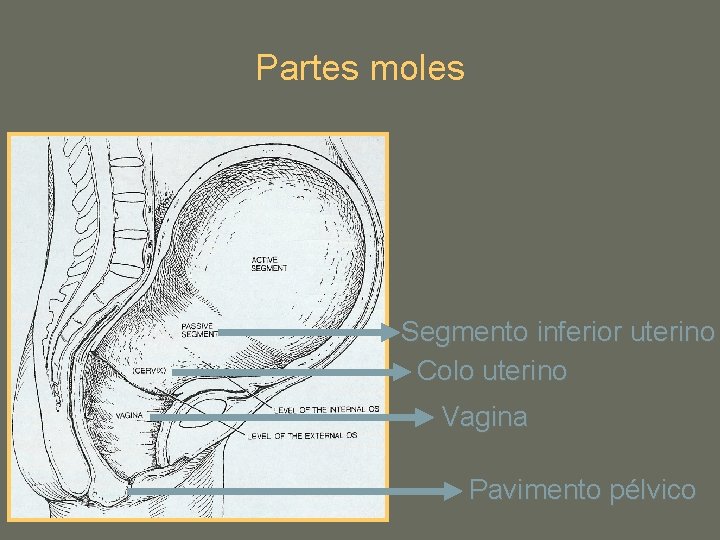 Partes moles Segmento inferior uterino Colo uterino Vagina Pavimento pélvico 