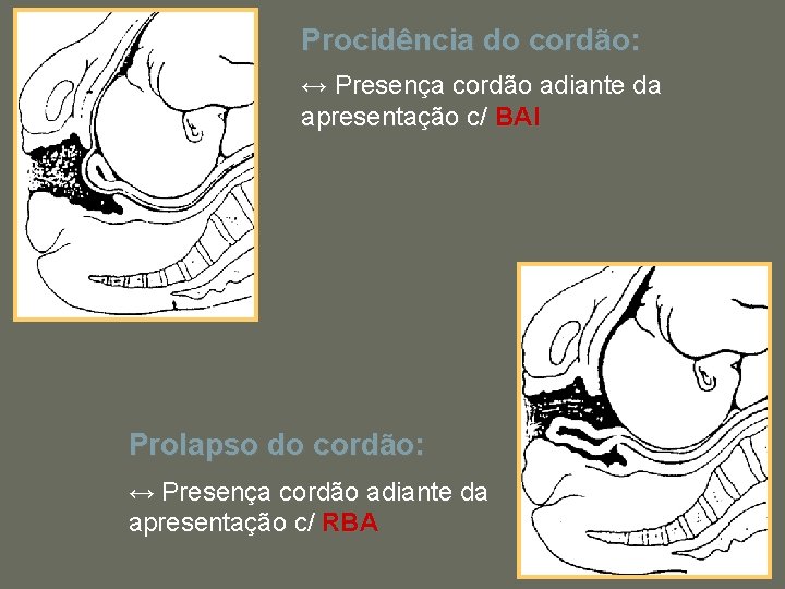 Procidência do cordão: ↔ Presença cordão adiante da apresentação c/ BAI Prolapso do cordão: