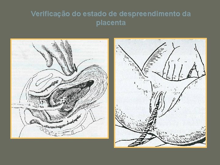 Verificação do estado de despreendimento da placenta 