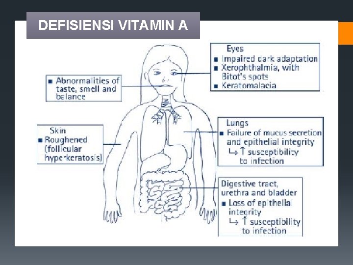 DEFISIENSI VITAMIN A 