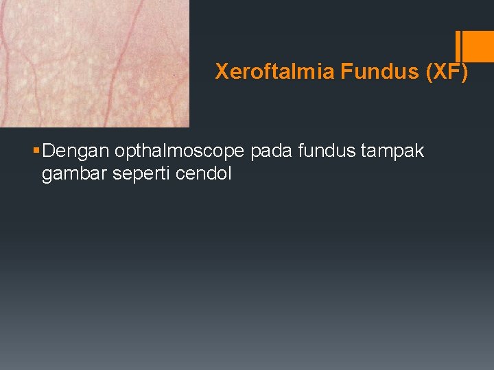 Xeroftalmia Fundus (XF) § Dengan opthalmoscope pada fundus tampak gambar seperti cendol 