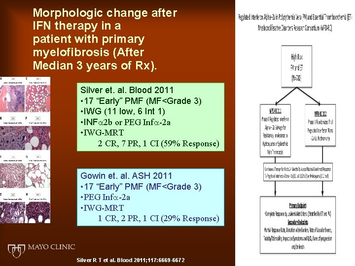 Morphologic change after IFN therapy in a patient with primary myelofibrosis (After Median 3