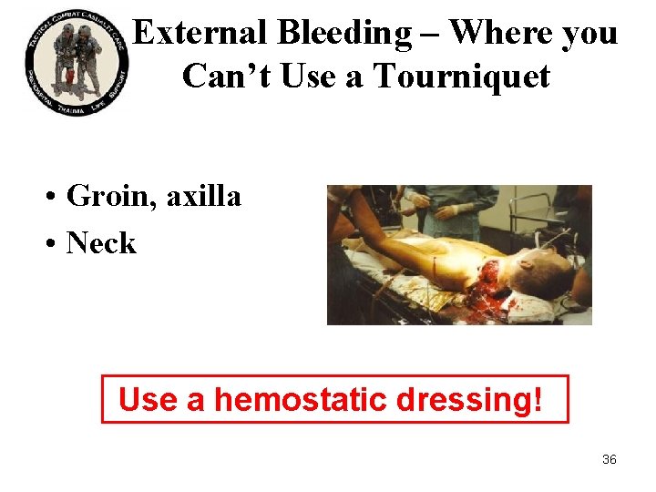 External Bleeding – Where you Can’t Use a Tourniquet • Groin, axilla • Neck External Bleeding – Where you Can’t Use a Tourniquet • Groin, axilla • Neck