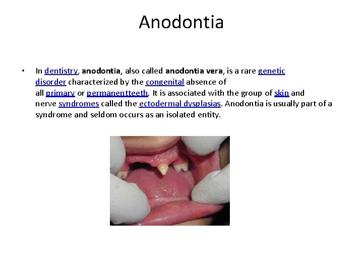 Anodontia • In dentistry, anodontia, also called anodontia vera, is a rare genetic disorder