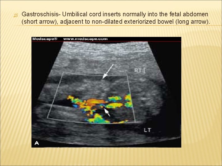  Gastroschisis- Umbilical cord inserts normally into the fetal abdomen (short arrow), adjacent to