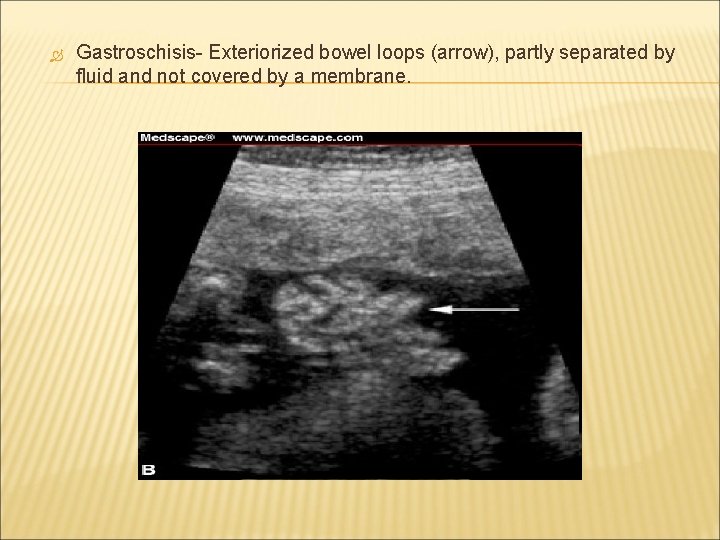  Gastroschisis- Exteriorized bowel loops (arrow), partly separated by fluid and not covered by