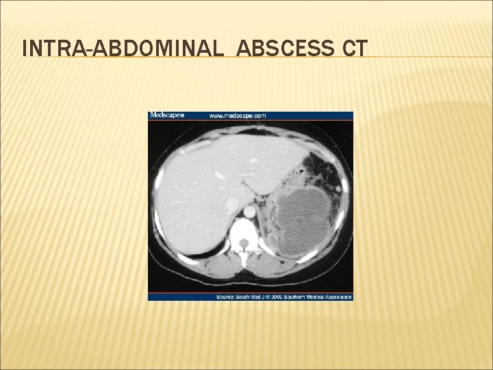 INTRA-ABDOMINAL ABSCESS CT 