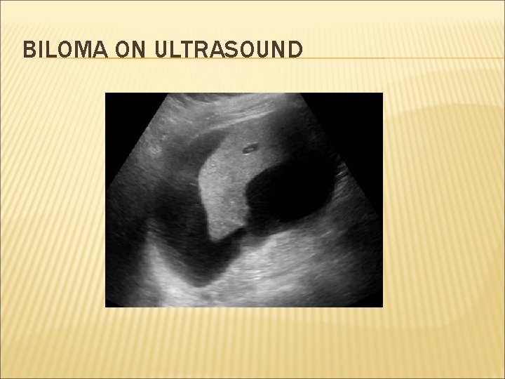 BILOMA ON ULTRASOUND 