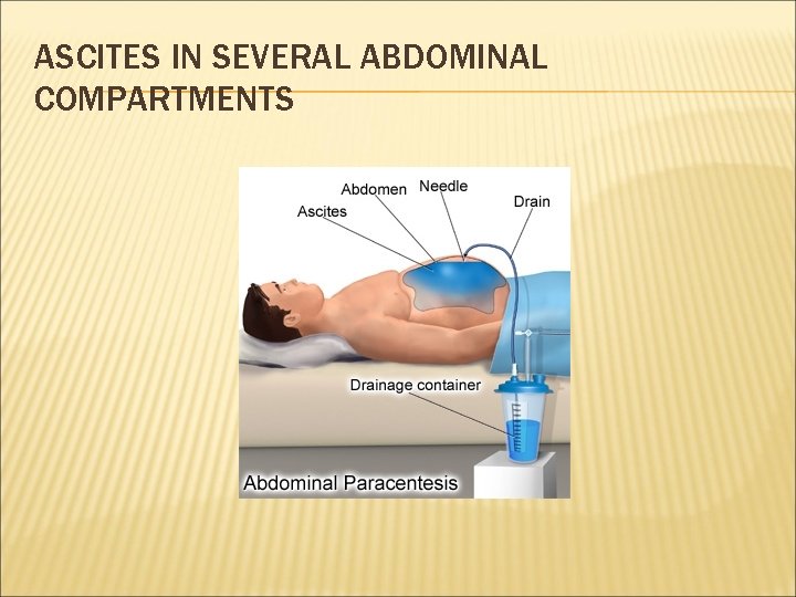 ASCITES IN SEVERAL ABDOMINAL COMPARTMENTS 