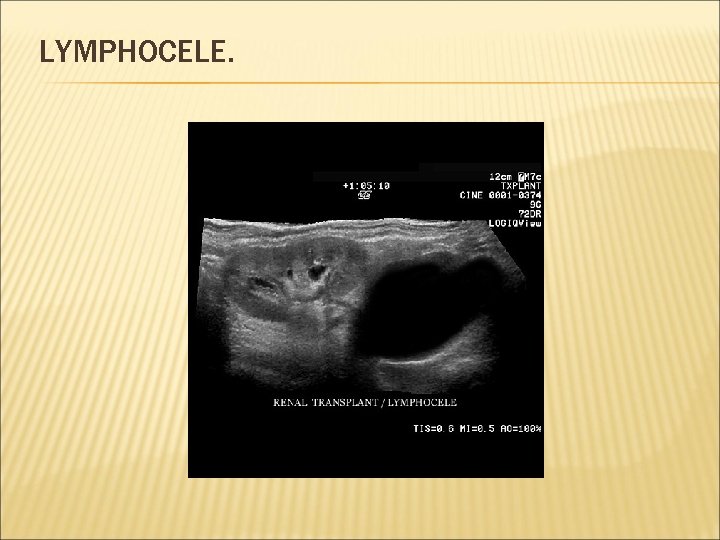 LYMPHOCELE. 