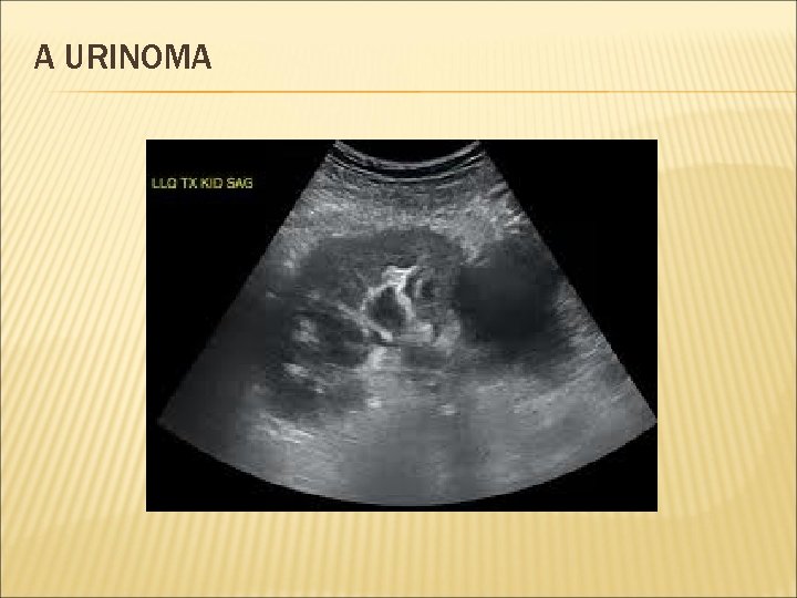 A URINOMA 