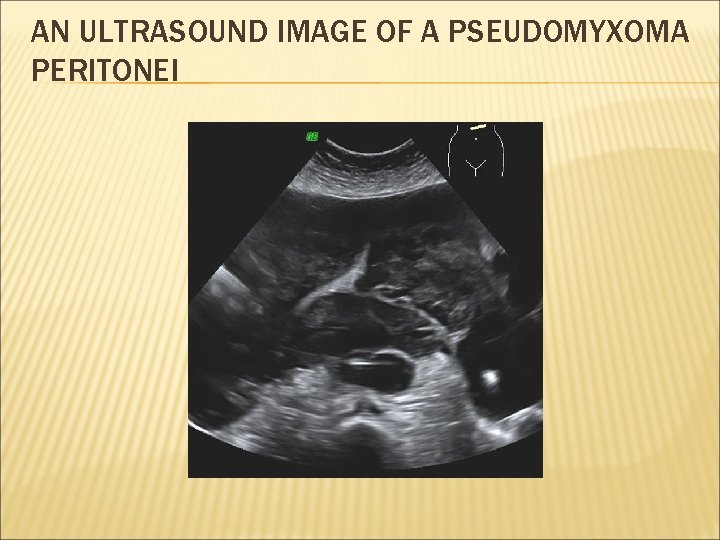 AN ULTRASOUND IMAGE OF A PSEUDOMYXOMA PERITONEI 