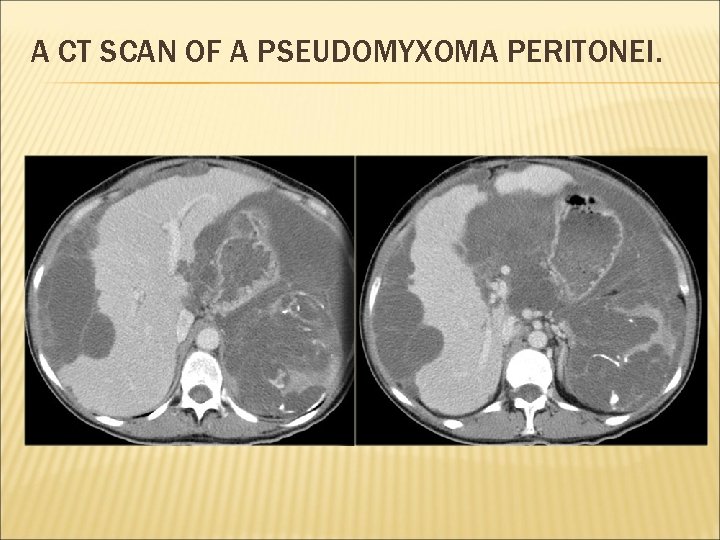 A CT SCAN OF A PSEUDOMYXOMA PERITONEI. 