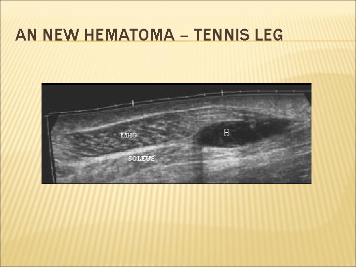 AN NEW HEMATOMA – TENNIS LEG 