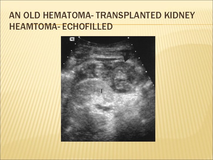 AN OLD HEMATOMA- TRANSPLANTED KIDNEY HEAMTOMA- ECHOFILLED 