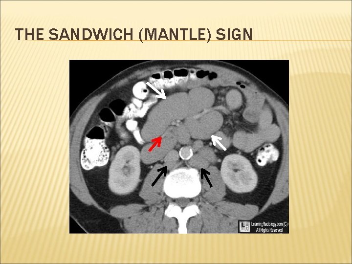 THE SANDWICH (MANTLE) SIGN 