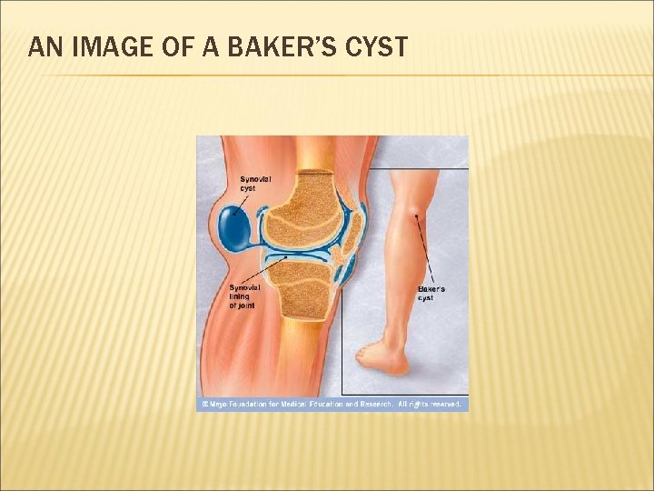 AN IMAGE OF A BAKER’S CYST 
