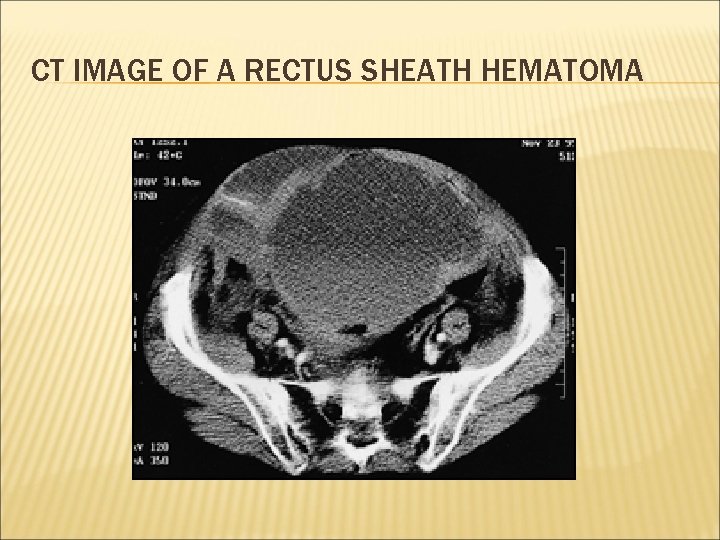 CT IMAGE OF A RECTUS SHEATH HEMATOMA 