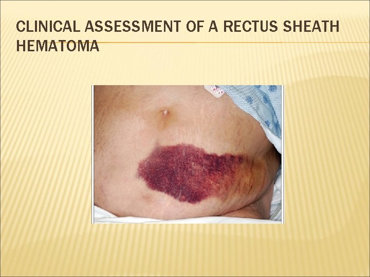 CLINICAL ASSESSMENT OF A RECTUS SHEATH HEMATOMA 