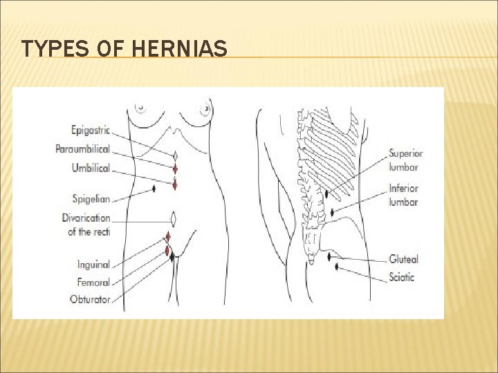 TYPES OF HERNIAS 