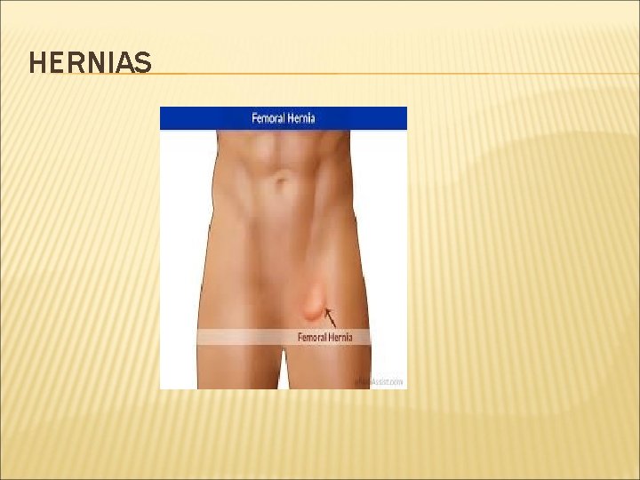 HERNIAS 