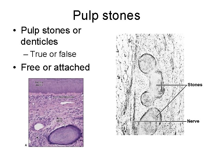 Pulp stones • Pulp stones or denticles – True or false • Free or