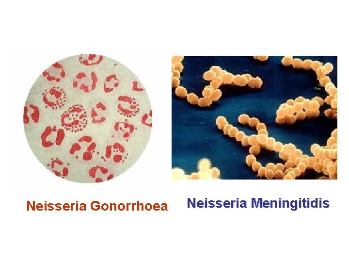 Neisseria Gonorrhoea Neisseria Meningitidis 