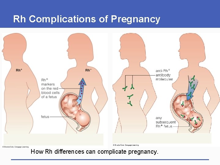 Rh Complications of Pregnancy How Rh differences can complicate pregnancy. 