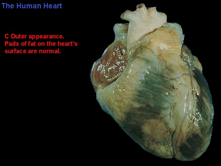 The Human Heart C Outer appearance. Pads of fat on the heart’s surface are