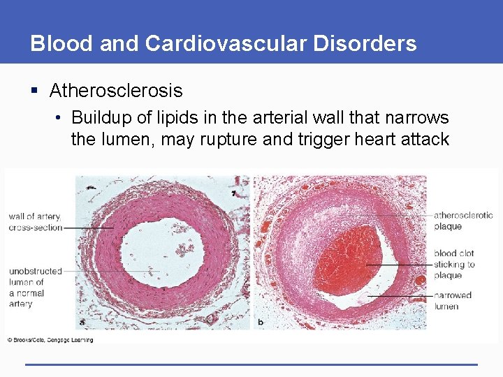 Blood and Cardiovascular Disorders § Atherosclerosis • Buildup of lipids in the arterial wall