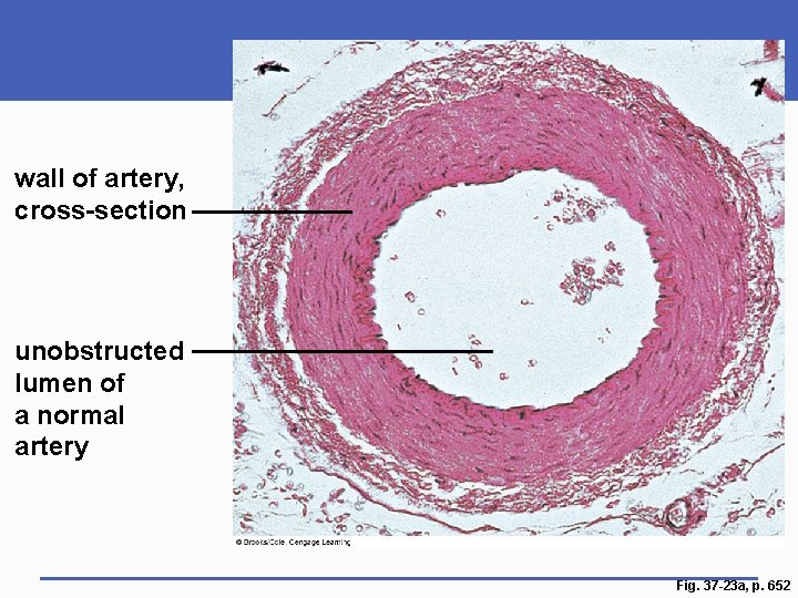 wall of artery, cross-section unobstructed lumen of a normal artery Fig. 37 -23 a,