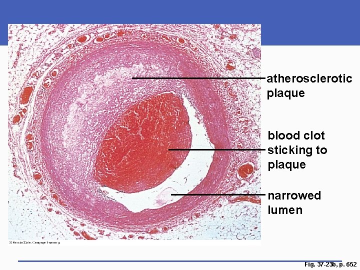 atherosclerotic plaque blood clot sticking to plaque narrowed lumen Fig. 37 -23 b, p.