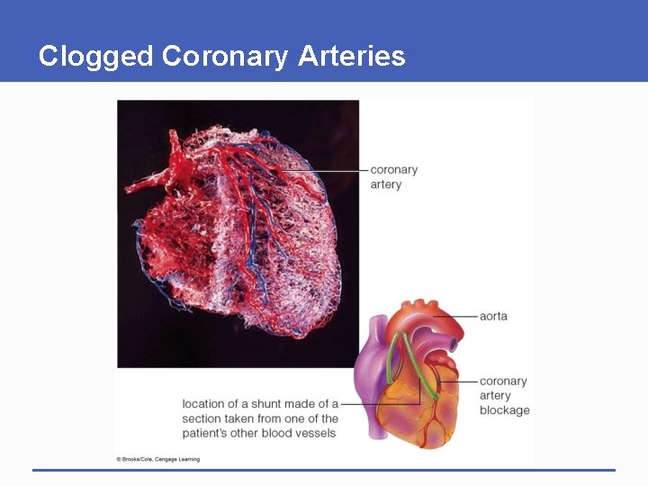 Clogged Coronary Arteries 