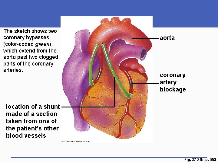 The sketch shows two coronary bypasses (color-coded green), which extend from the aorta past